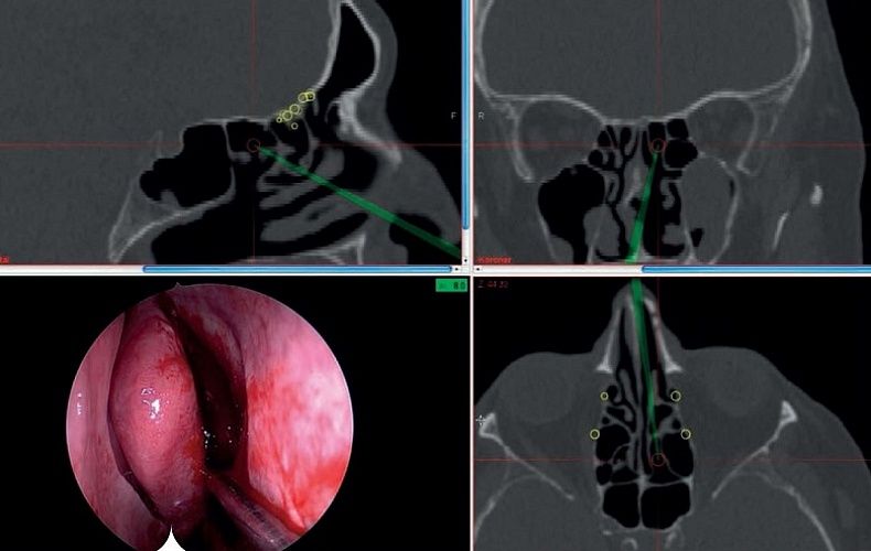 Фиброволоконная эндоскопия подвздошной кишки