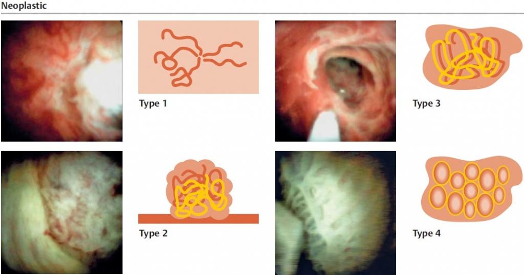 хоолангиоскопия_классификация_Неопластические_обраозвания_2018_EndoExpert.ru