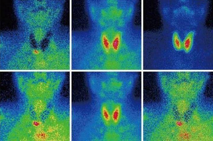 Сцинтиграфия щитовидной железы Сцинтиграфия щитовидной железы