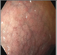 Целиакия-это хроническое мультифакториальное заболевание,  вызванное повреждением ворсинок тонкой кишки некоторыми пищевыми продуктами, содержащими определённые белки: глютен (клейковину) и близкие к нему белки злаков (авенин, гордеин и др.)и приводящее к плотной инфильтрации лимфоцитов в проксимальном отделе тонкой кишки. 