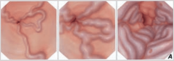 Классификация варикозного расширения вен пищевода