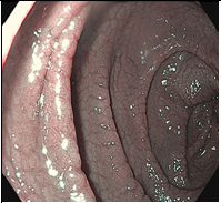 Целиакия-это хроническое мультифакториальное заболевание,  вызванное повреждением ворсинок тонкой кишки некоторыми пищевыми продуктами, содержащими определённые белки: глютен (клейковину) и близкие к нему белки злаков (авенин, гордеин и др.)и приводящее к плотной инфильтрации лимфоцитов в проксимальном отделе тонкой кишки. 