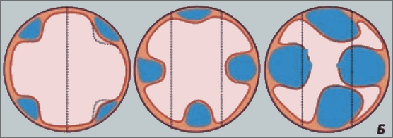 Усовершенствованная классификация (рекомендована ESGE)