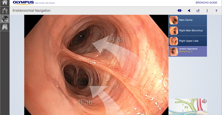 bronch бронхоскопия ЭндоЭксперт рекомендует.png