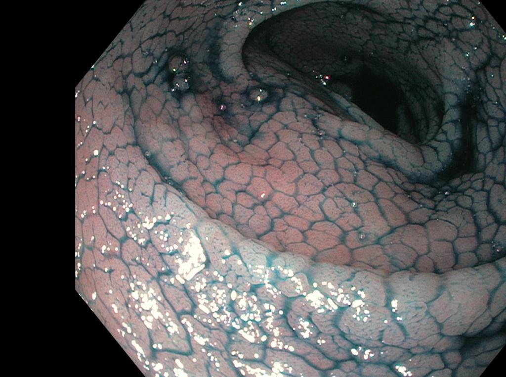 Гистологическое заключение: целиакия тип 3b за Marsh–Oberhuber