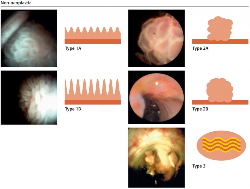 хоолангиоскопия_классификация_не_неопластические_образования__2018_EndoExpert.ru
