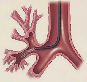 Бронхиальная термопластика