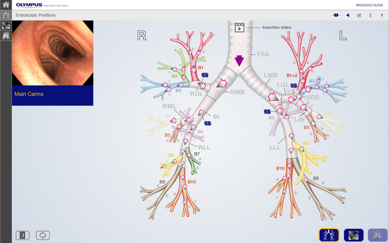 bronch ТБД бронхоскопия ЭндоЭксперт рекомендует 770.png