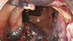 Антикоагулянты. Варфарин в эндоскопии. Процедуры высокого риска. По материалам ESGE
