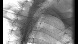 КОМБИНИРОВАННОЕ СТЕНТИРОВАНИЕ ТРАХЕИ И ПИЩЕВОДА