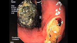 Эндоскопическое удаление фитобезоара из хурмы. 2 этапа+ кока-кола терапия.