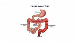 Классификация язвенного колита по Schroeder в зависимости от эндоскопической активности