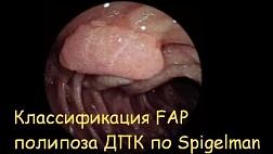 Классификация Шпигельмана (Spigelman, 1989) Оценка тяжести полипоза двенадцатиперстной кишки