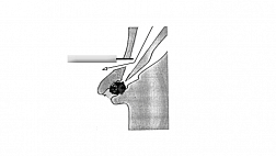Предварительная сфинктеротомия