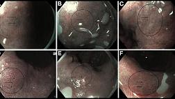 Классификация ранней аденокарциномы Барретта BING, 2016. Разработка и валидация системы классификации для выявления дисплазии высокой степени и аденокарциномы пищевода при пищеводе Барретта с использованием узкоспектральной визуализации