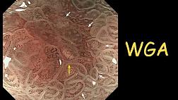 "Появление белых сфер" “white globe appearance” (WGA) новый маркер для правильной диагностики раннего рака желудка с помощью эндоскопии с увеличением и узкоспектральной визуализацией (M-NBI)