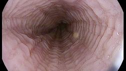 Анкета: информация о ПАЦИЕНТЕ "Статистика выявления Эозинофильного эзофагита в России 2018