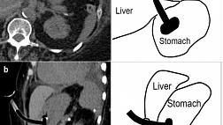 ПОВРЕЖДЕНИЕ ПЕЧЕНИ ПРИ ГАСТРОСТОМИИ