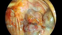 Кистозный лимфангиоматоз