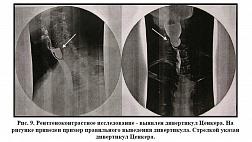Диагностика и лечение дивертикулов Ценкера