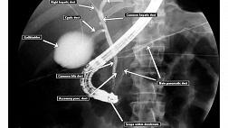 Российский консенсус по актуальным вопросам диагностики и лечения синдрома механической желтухи