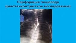 ПЕРФОРАЦИЯ ПИЩЕВОДА У ДЕТЕЙ: ЭТИОЛОГИЯ, КЛИНИКА, ДИАГНОСТИКА, ЛЕЧЕНИЕ