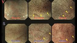 Эндоскопическая классификация VS Vessels and surface (сосуды и поверхность) для дифференциальной диагностики раннего рака желудка