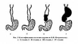 Ахалазия кардии