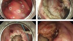 ЗАКРЫТИЕ ДЕФЕКТОВ ЖЕЛУДКА