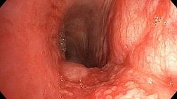 Трансбронхиальная криобиопсия легкого