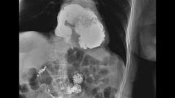 Триада Сейнта с дивертикулезом тощей кишки - редкая разновидность синдрома