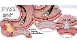 Что такое EPASS-assisted EUS-GE ?