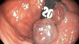 Необычные полипы прямой кишки.