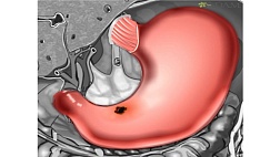 Проект Клинические рекомендации РОХ "Прободная язва-2023"
