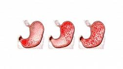 Хронический гастрит. Классификации Хьюстоновская модификация сиднейской системы хронических гастритов