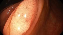 Видео случай. Комбинировання дифференциальная диагностика в случае инвертированного дивертикула.