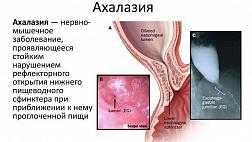 Рекомендации Российской гастроэнтерологической ассоциации по диагностике и лечению ахалазии кардии и кардиоспазма