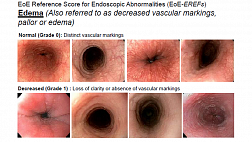 Presentation Ikuo Hirano MD, Eosinophilic Esophagitis, 2013