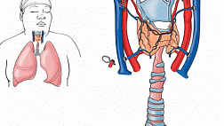 Команда хирургов Mount Sinai NY выполнила первую в истории успешную трансплантацию трахеи человека