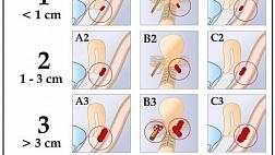 Классификация эндометриоза ENZIAN