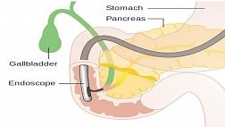 РОЛЬ ВНУТРИПРОСВЕТНЫХ ЭНДОСКОПИЧЕСКИХ ВМЕШАТЕЛЬСТВ В КОМПЛЕКСНОМ ЛЕЧЕНИИ ХРОНИЧЕСКОГО ПАНКРЕАТИТА И ЕГО ОСЛОЖНЕНИЙ автореферат