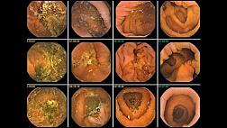 Возможности видеокапсульной эндоскопии в диагностике воспалительных заболеваний кишечника
