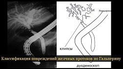 Классификация повреждений желчных протоков Э.И. Гальперин, 2008. Классификация высоких рубцовых стриктур по Э.И. Гальперину 2002