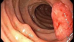 Индуцированные подготовкой колиты