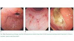 Вызванное лекарством повреждение слизистой оболочки (аспирин, нестероидное противовоспалительное средство): система оценки эндоскопии верхних отделов желудочно-кишечного тракта по Саймону, по Крайеру, шкала Ланца,  Алкогольное повреждение по Тарнавски
