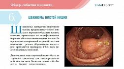 ШВАННОМА ТОЛСТОЙ КИШКИ