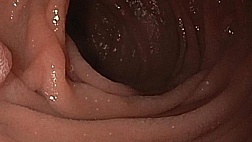 Дуоденальная лимфангиэктазия: эндоскопическая находка и её клиническая интерпретация. Классификация по Kim J.H.