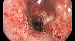 Гранулематоз Вегенера