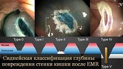 Сиднейская классификация оценка глубины повреждения стенки толстой кишки после эндоскопической резекции слизистой оболочки EMR.