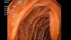 Тело поджелудочной железы